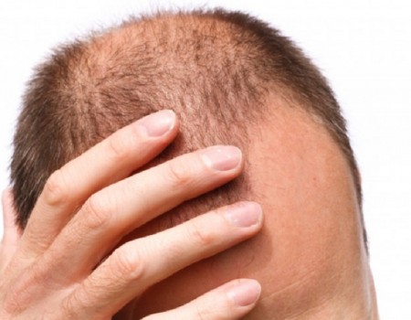 Minoxidil 5 contre perte de cheveux